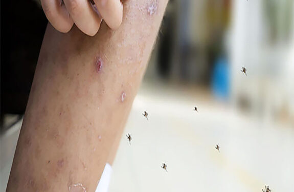 How to Get Rid of Mosquito Bite Scars